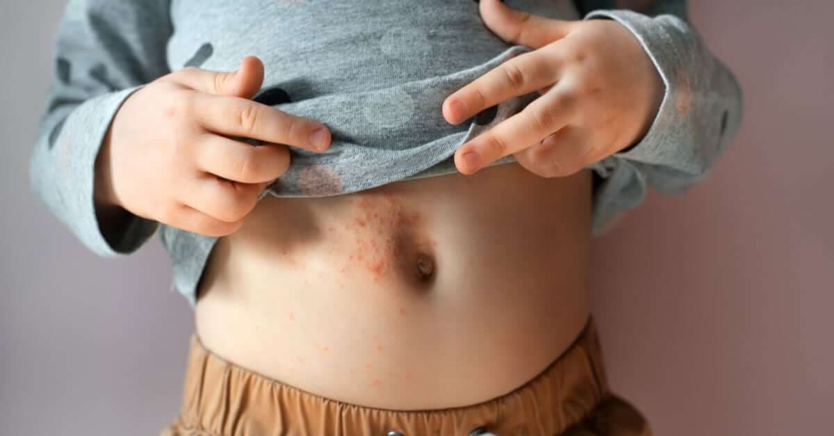 Uyuz Salgınından Bebeğinizi Nasıl Koruyabilirsiniz? kapak resmi